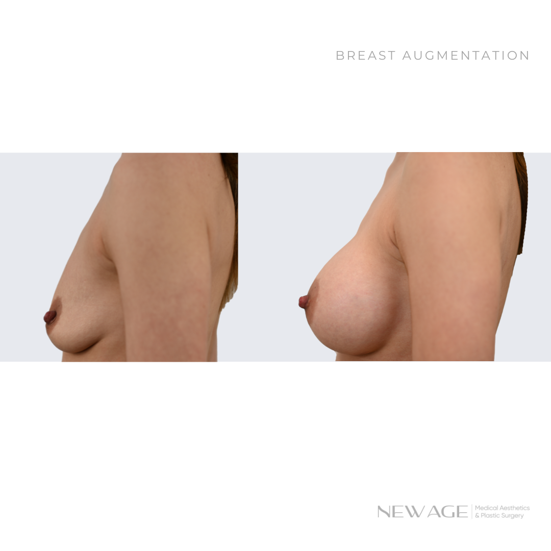 Breast Augmentation Before & After Photos Ottawa, Ontario Plastic Surgeon