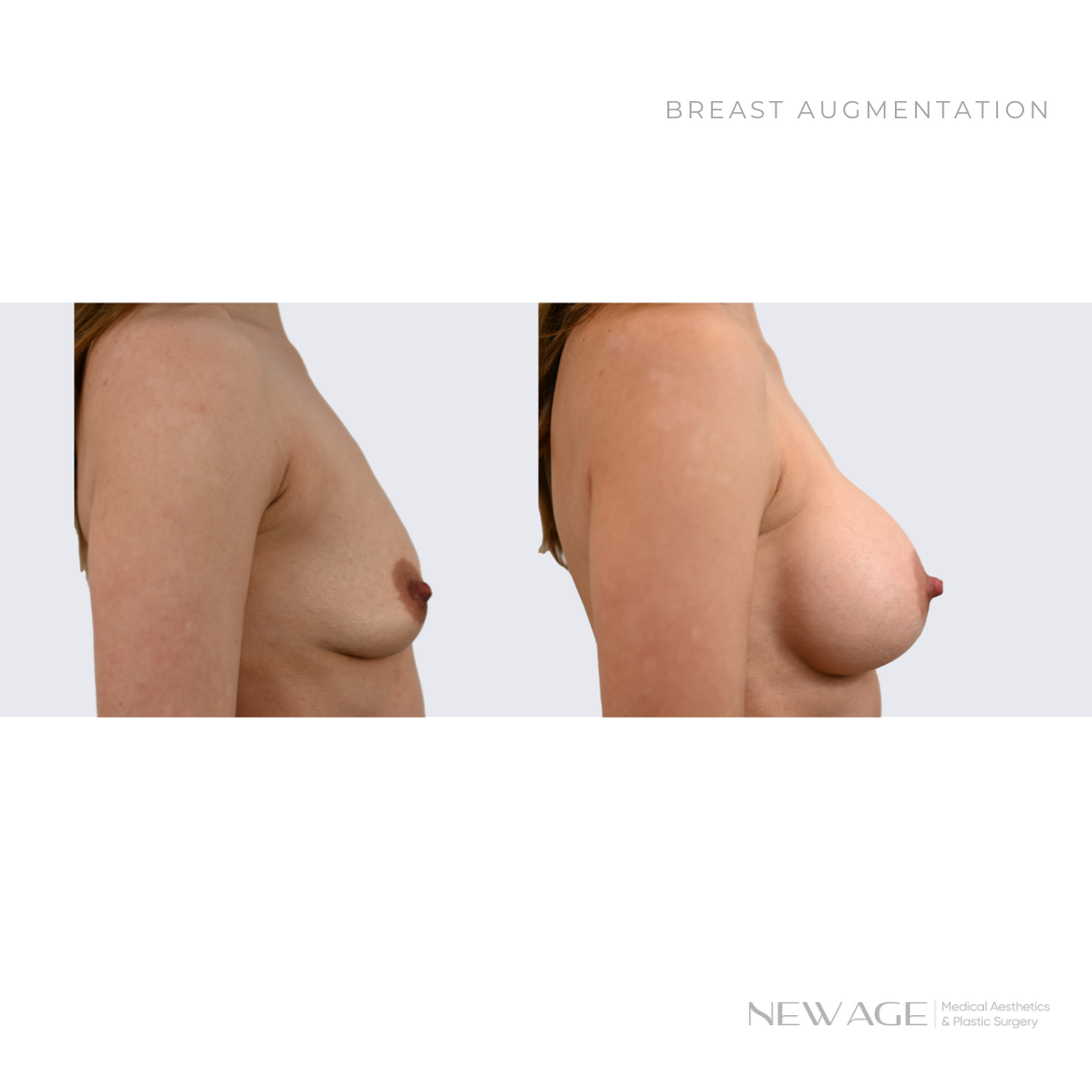 Breast Implant Before & After Photos Ottawa, Ontario