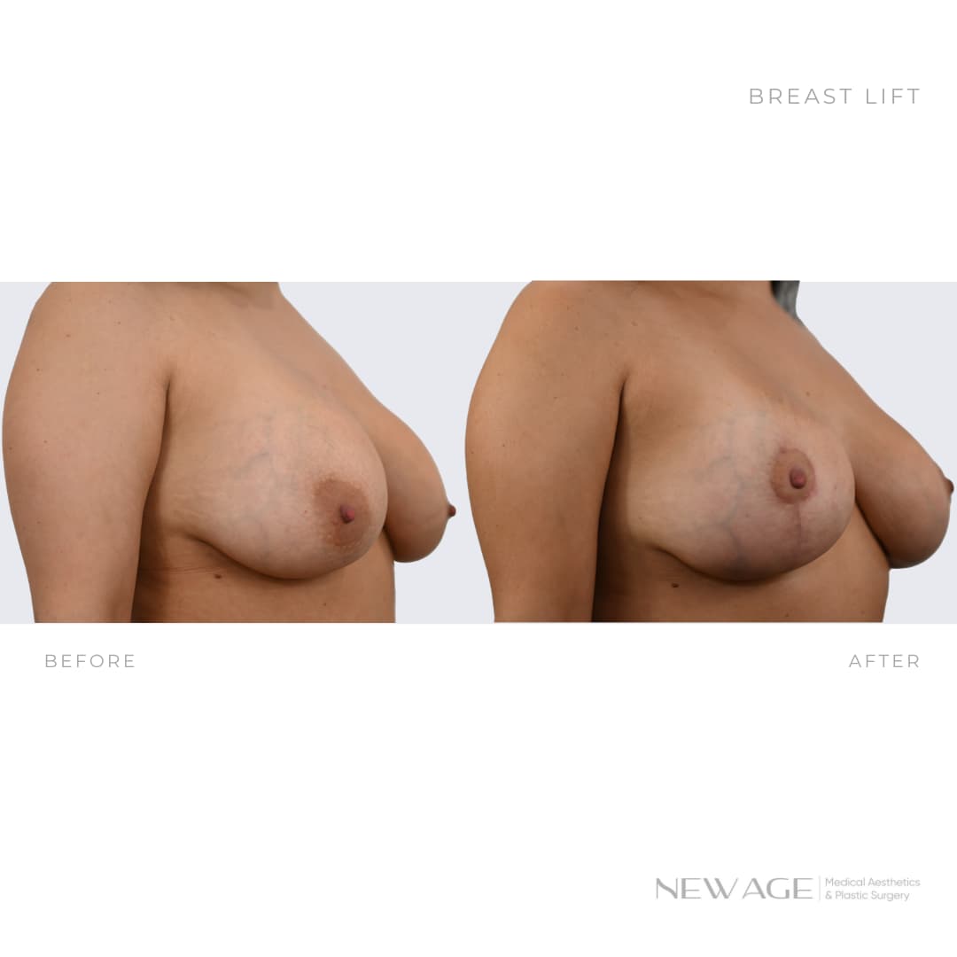 Breast Lift Before & After Photos Ottawa Board Certified Plastic Surgeon
