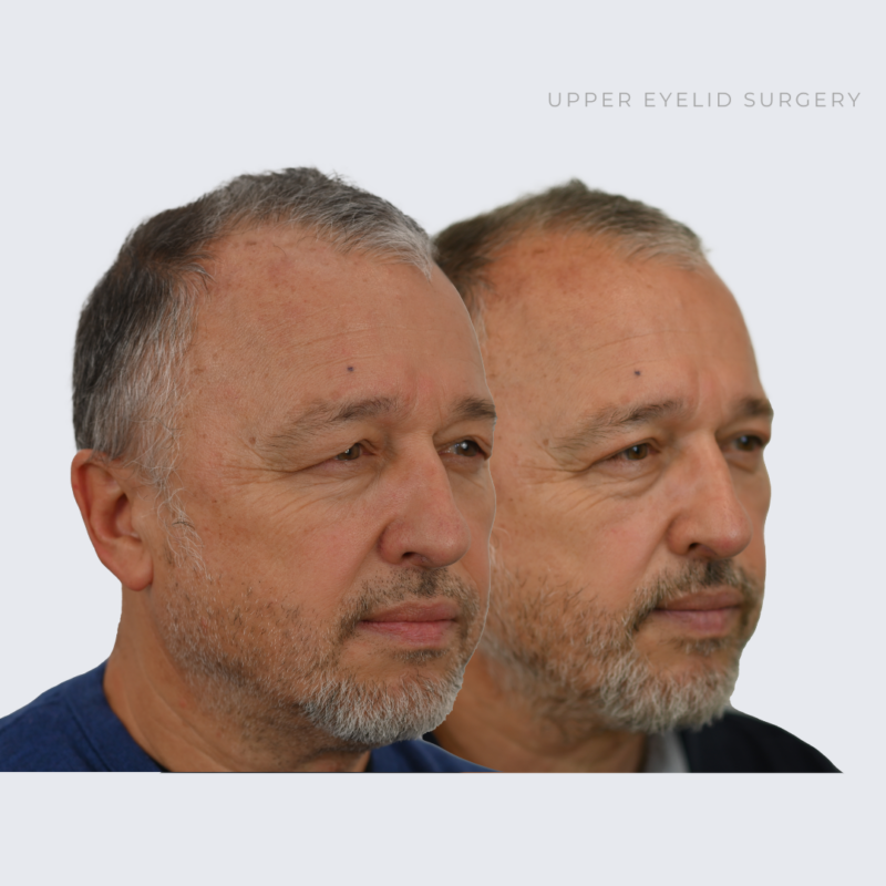 Upper Eyelid Surgery Ottawa, Ontario