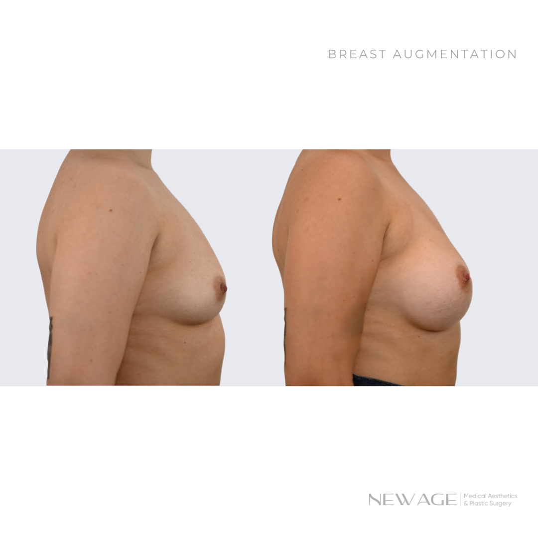 Breast Implants Before & After Ottawa Plastic Surgeon