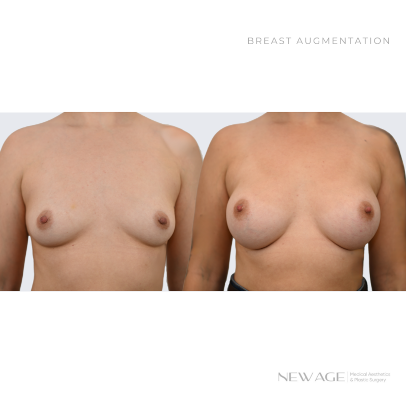 Breast Implants Before & After Photos Ottawa Plastic Surgeon