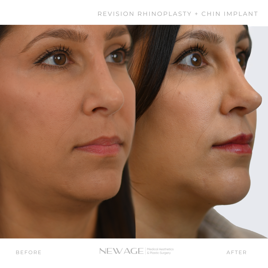 Before & After Rhinoplasty Chin Implant Plastic Surgeon Ottawa