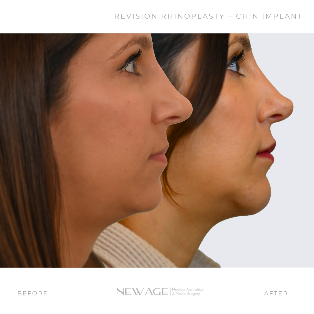 Before & After Rhinoplasty + Chin Implant in Ottawa Plastic Surgeon