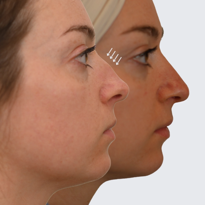 Before & After Rhinoplasty in Ottawa