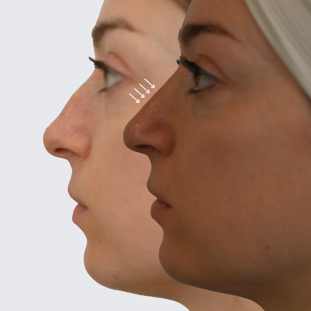 Nose Job Before & After Ottawa