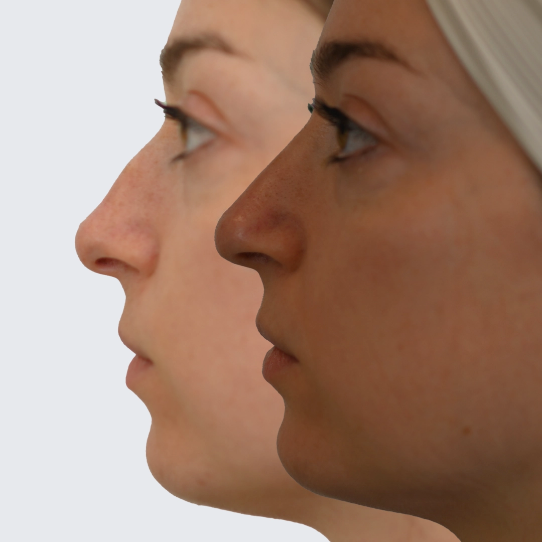 Rhinoplasty Before & After Photos Ottawa