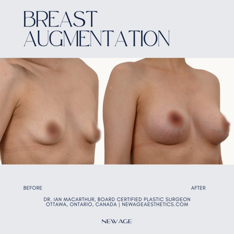 Breast Augmentation Before & After Ottawa ON CA