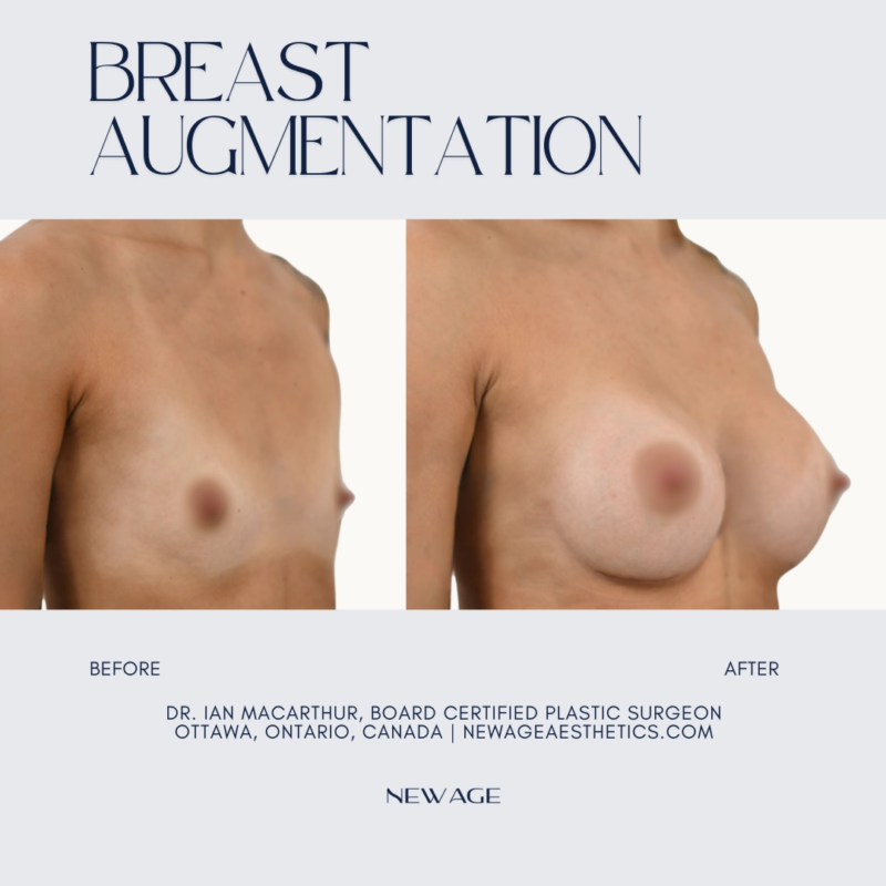 Breast Augmentation Before & Afters in Ottawa, Ontario, Canada