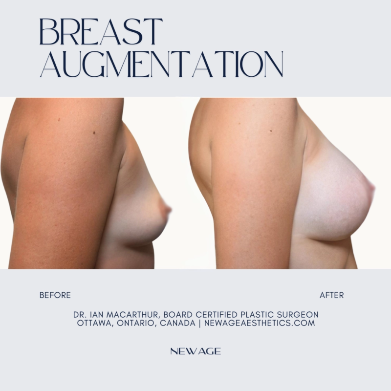 Breast Implants Before & After Photos Ottawa, Ontario