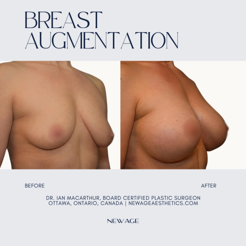Breast Implants Before & After Photos in Ottawa, Ontario, Canada