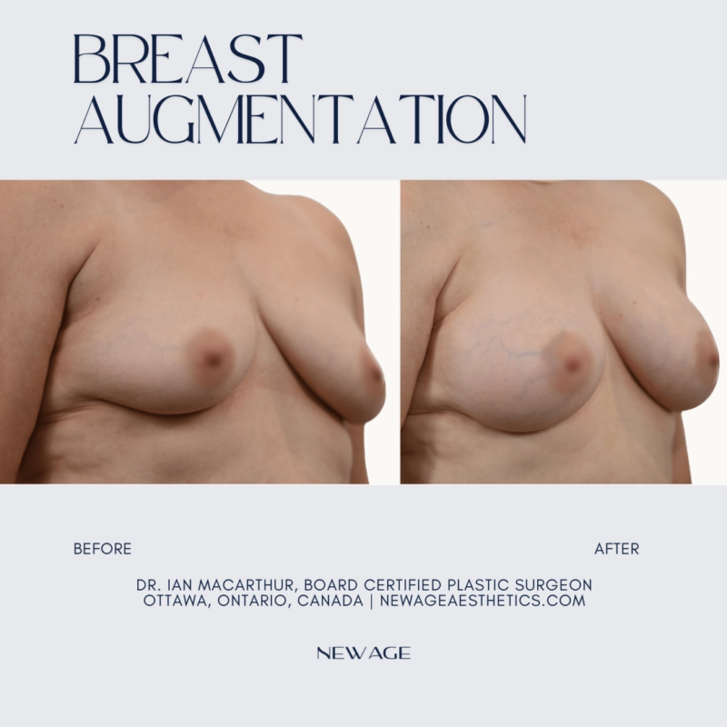 Breast Implants Breast Augmentation Ottawa, Ontario