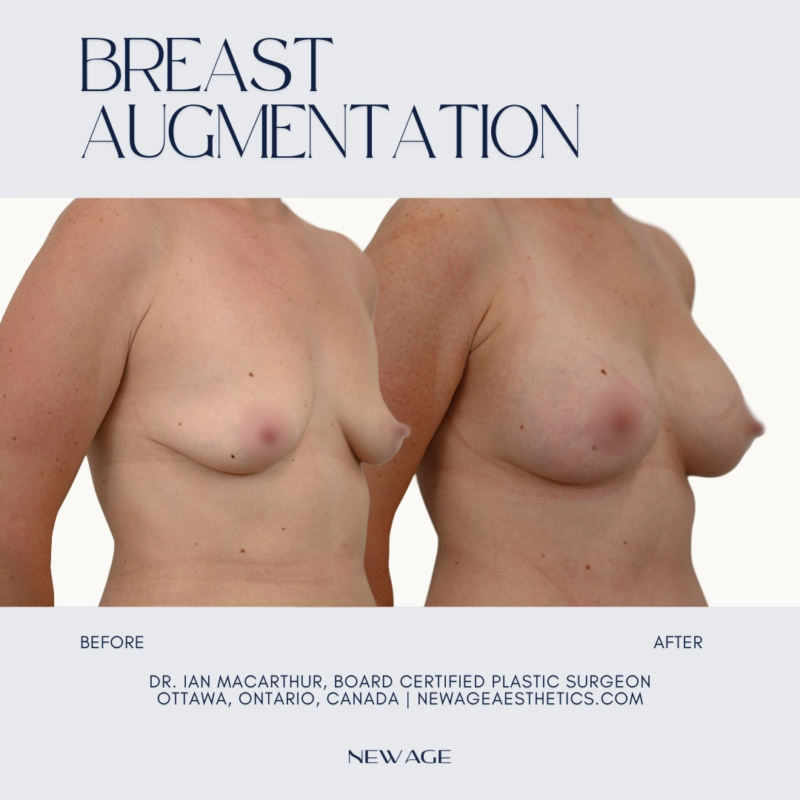 Breast Implatns Before & After in Ottawa, ON Plastic Surgeon