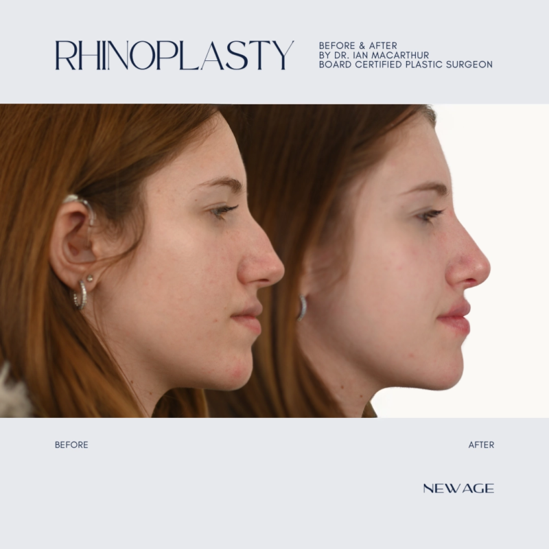 RHINOPLASTY BEFORE & AFTER OTTAWA