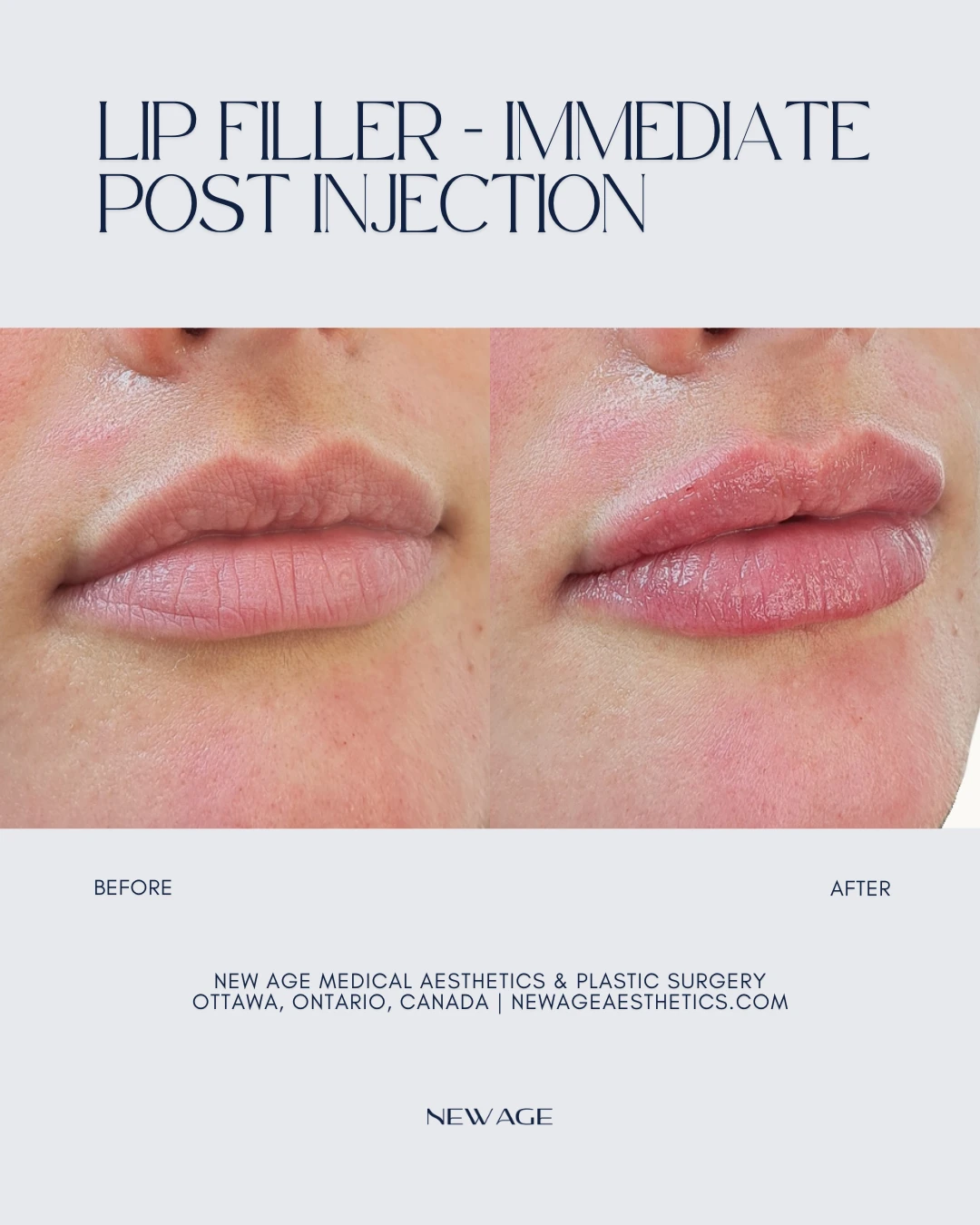 Lip Filler Before & After Results in Ottawa, Ontario
