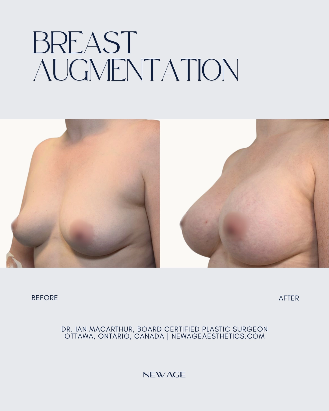 Before & After Breast Augmentation Ottawa, Ontario