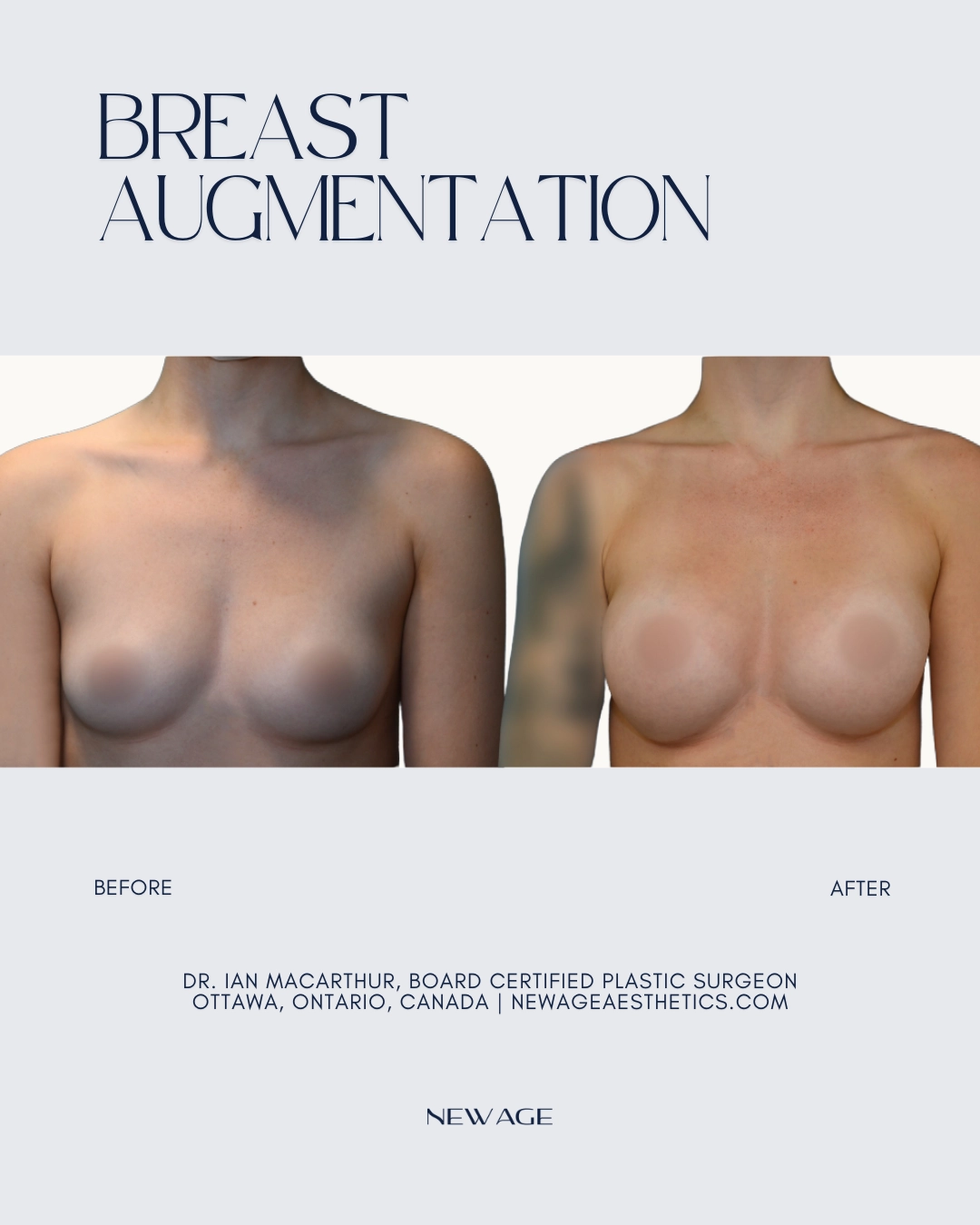 Before & After Breast Implants Breast Augmentation Ottawa Plastic Surgeon