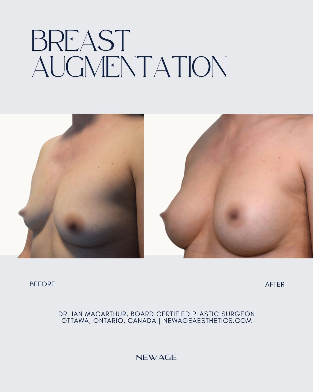 Before & After Breast Implants Ottawa, Ontario, Canada Plastic Surgeon