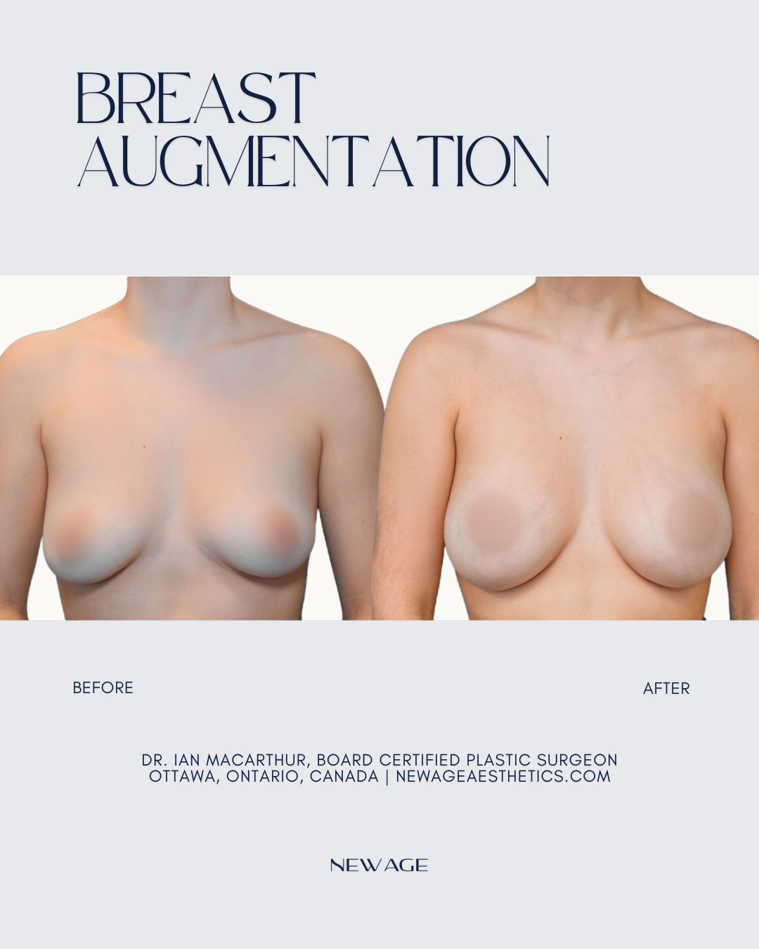 Breast Implants Before & After in Ottawa, Ontario Plastic Surgeon