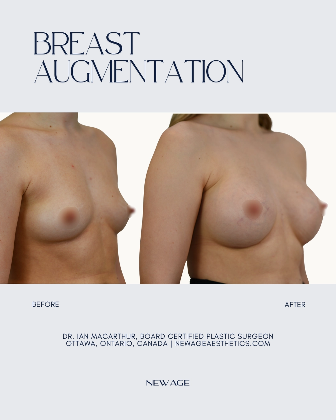 Breast Implants Breast Augmentation Before & After Photos